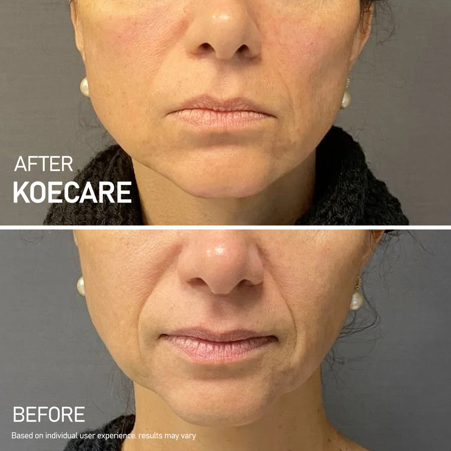 KOECARE skincare result