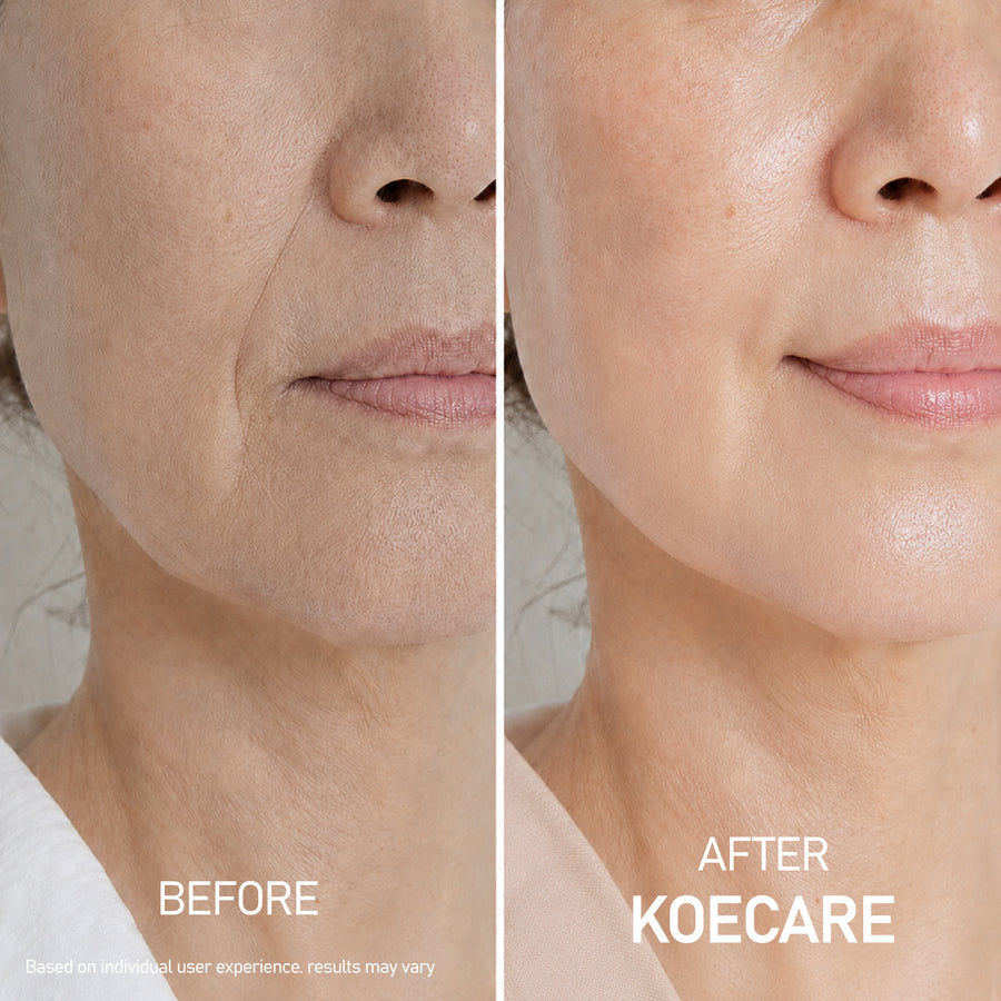 KOECARE skincare result