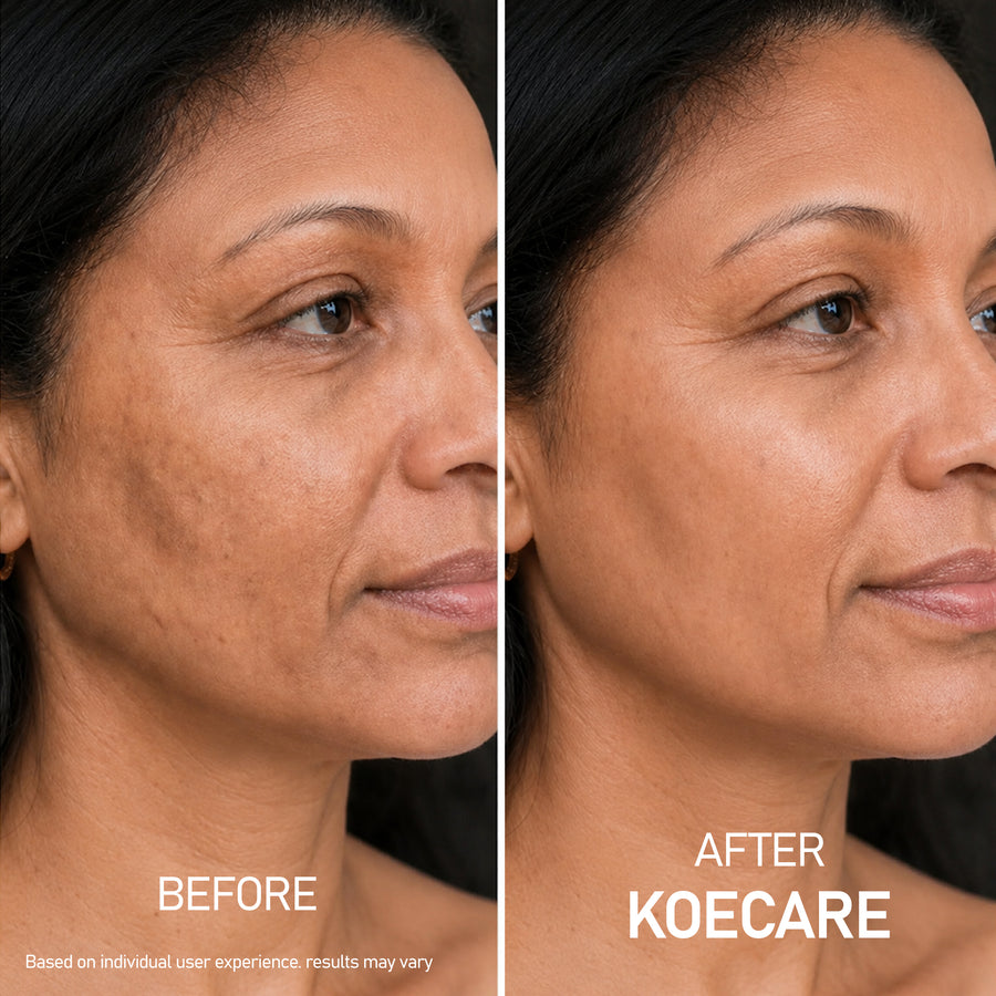 KOECARE skincare result